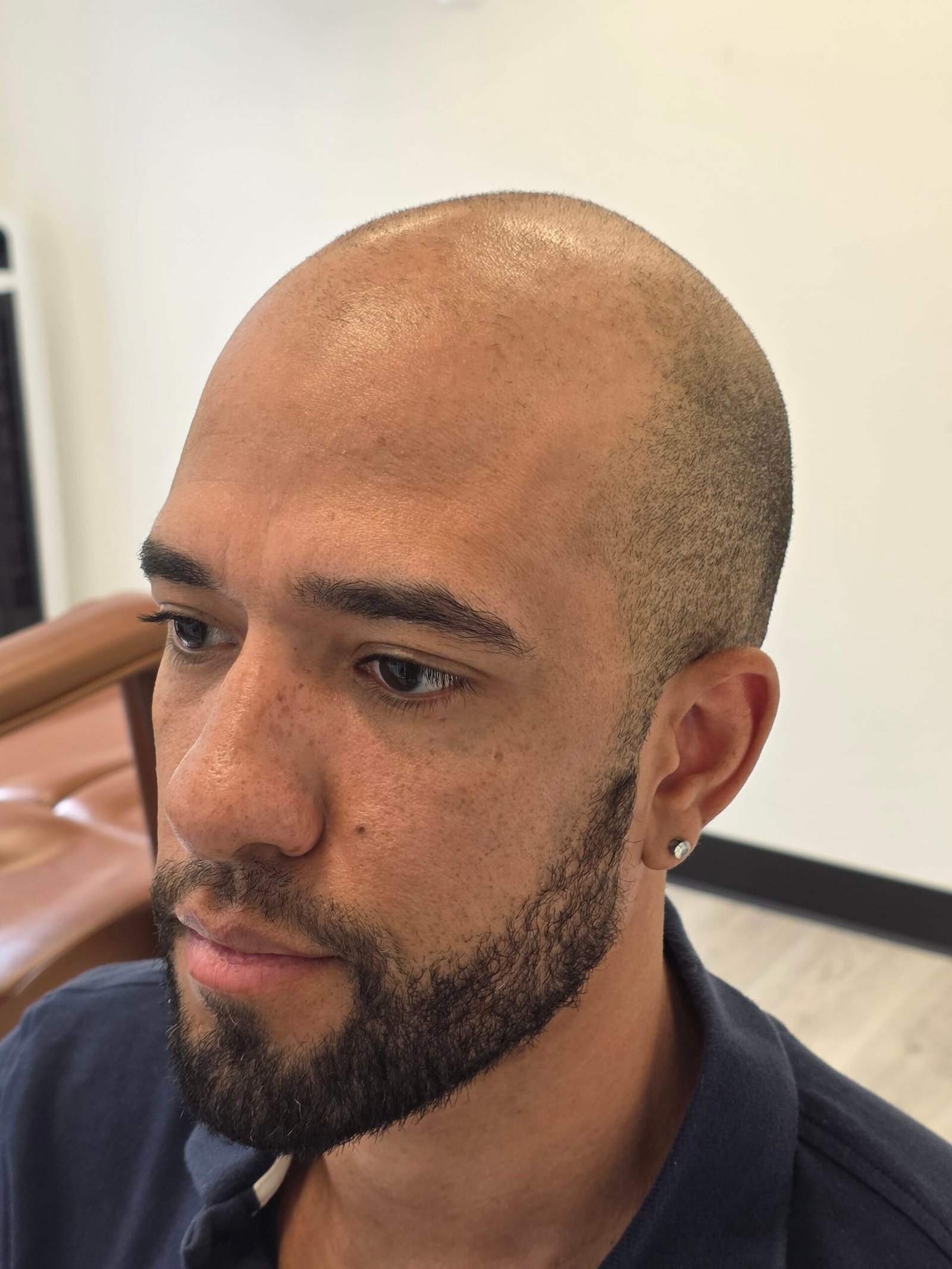Before scalp micropigmentation treatment showing the client’s natural hairline and scalp prior to SMP