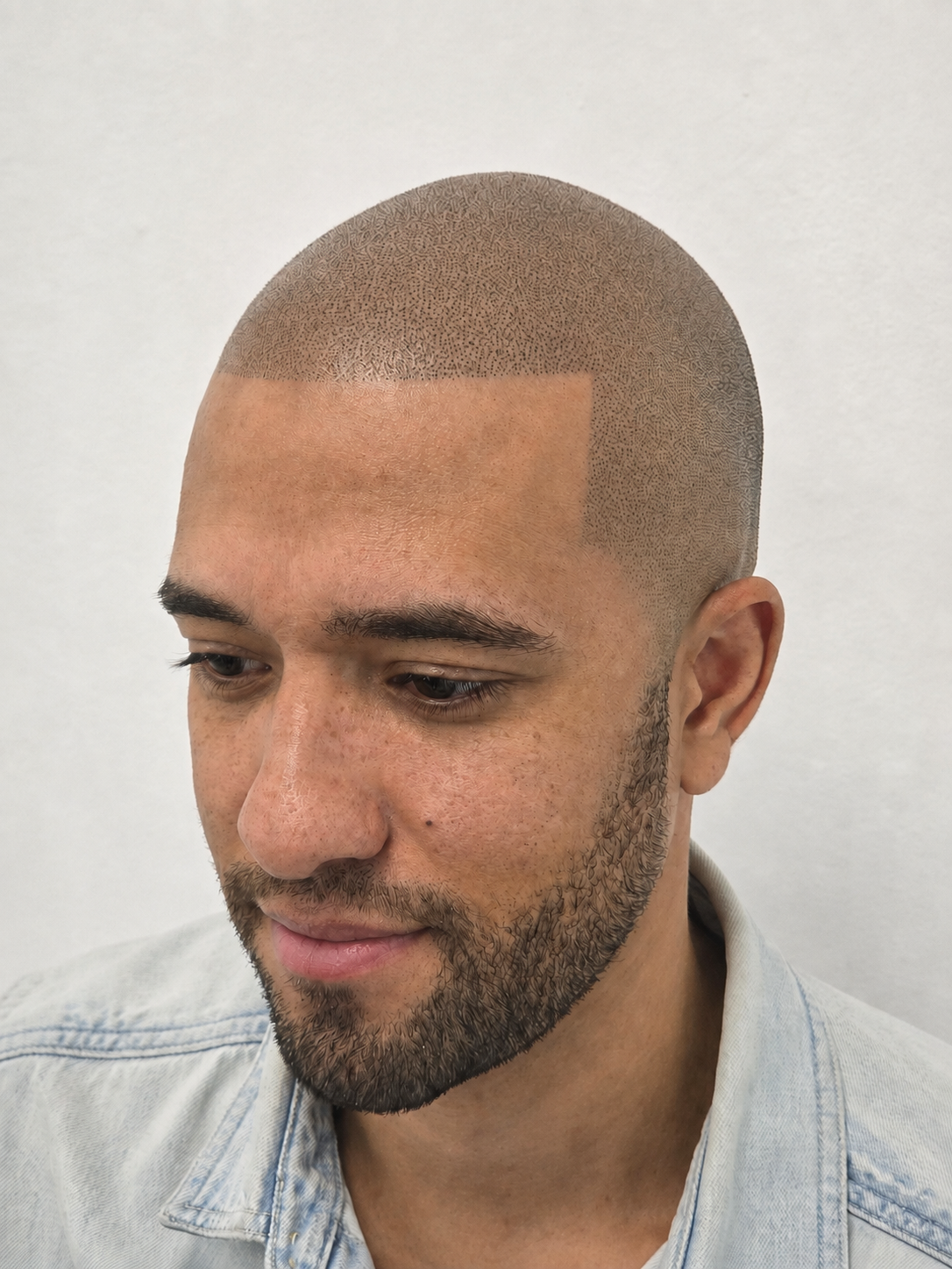 Natural scalp micropigmentation hairline and density result on a male client.