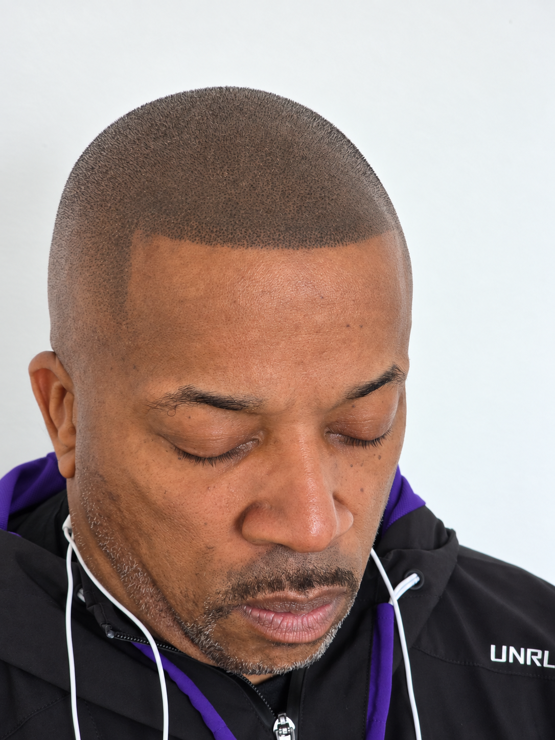 After photo showing corrected scalp micropigmentation with improved blending and natural density by Don Whyte