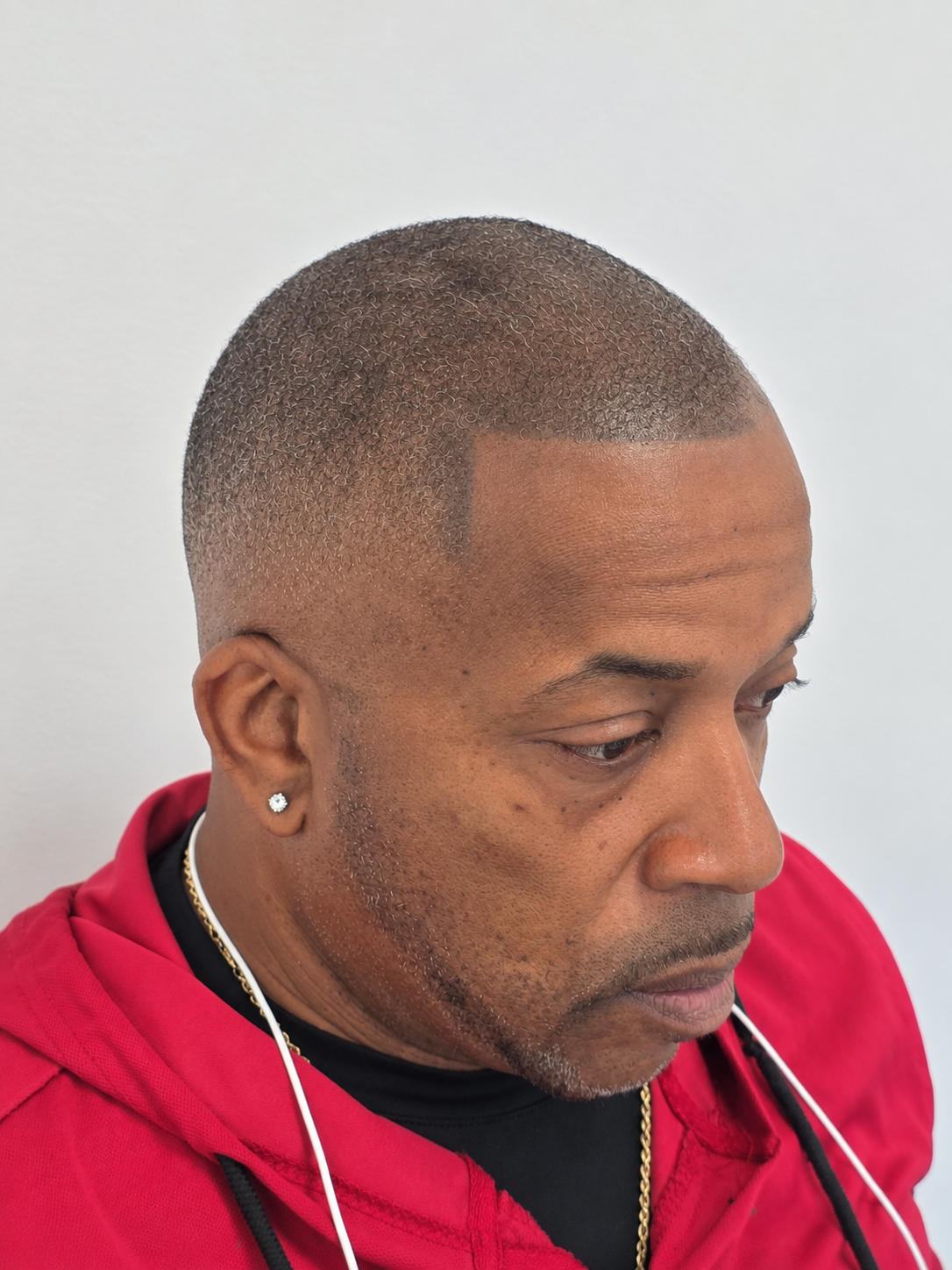Before photo showing previous scalp micropigmentation prior to SMP correction by Don Whyte