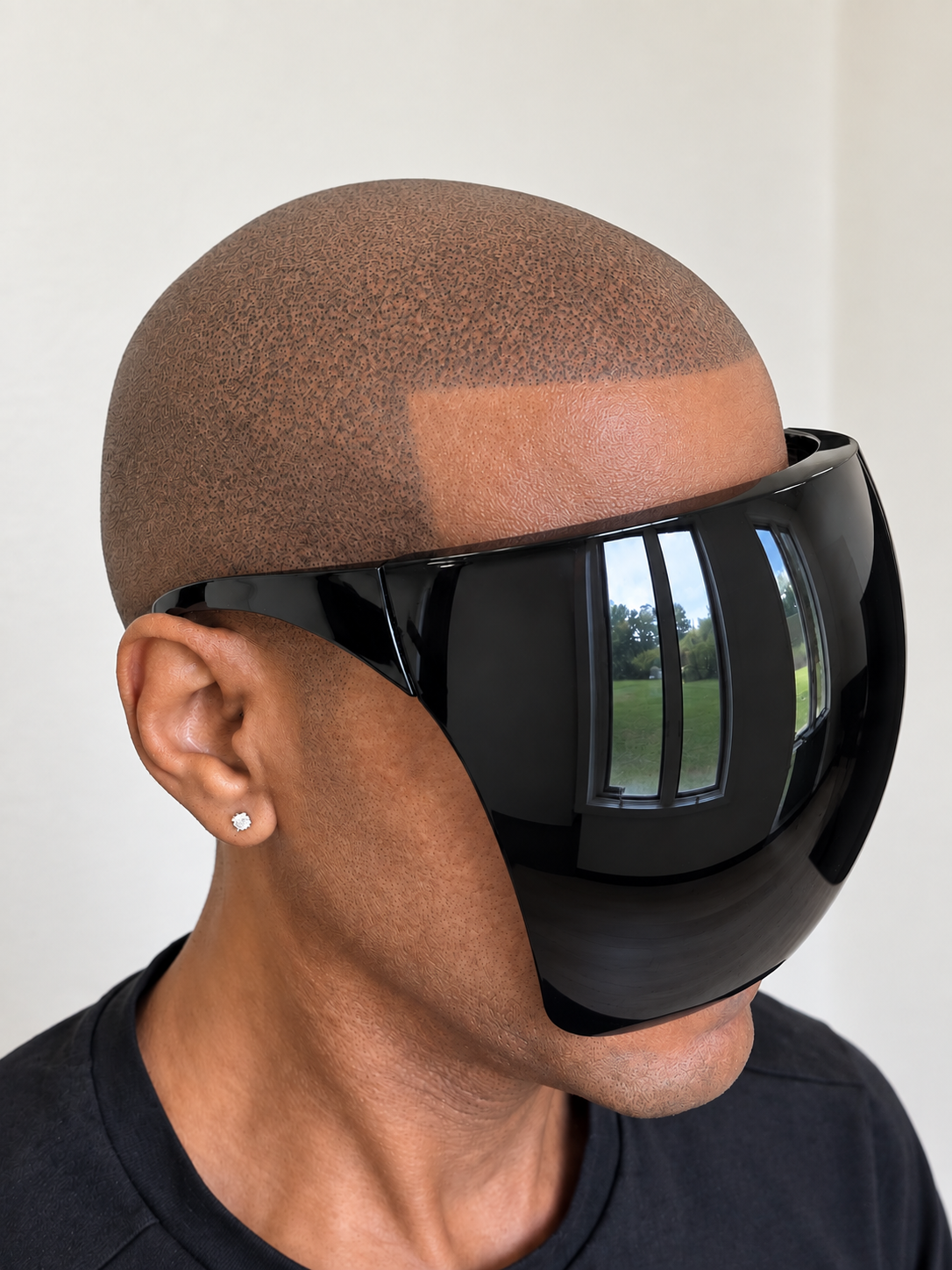 Side profile showing a scalp micropigmentation correction with a refined hairline and more natural follicle appearance.