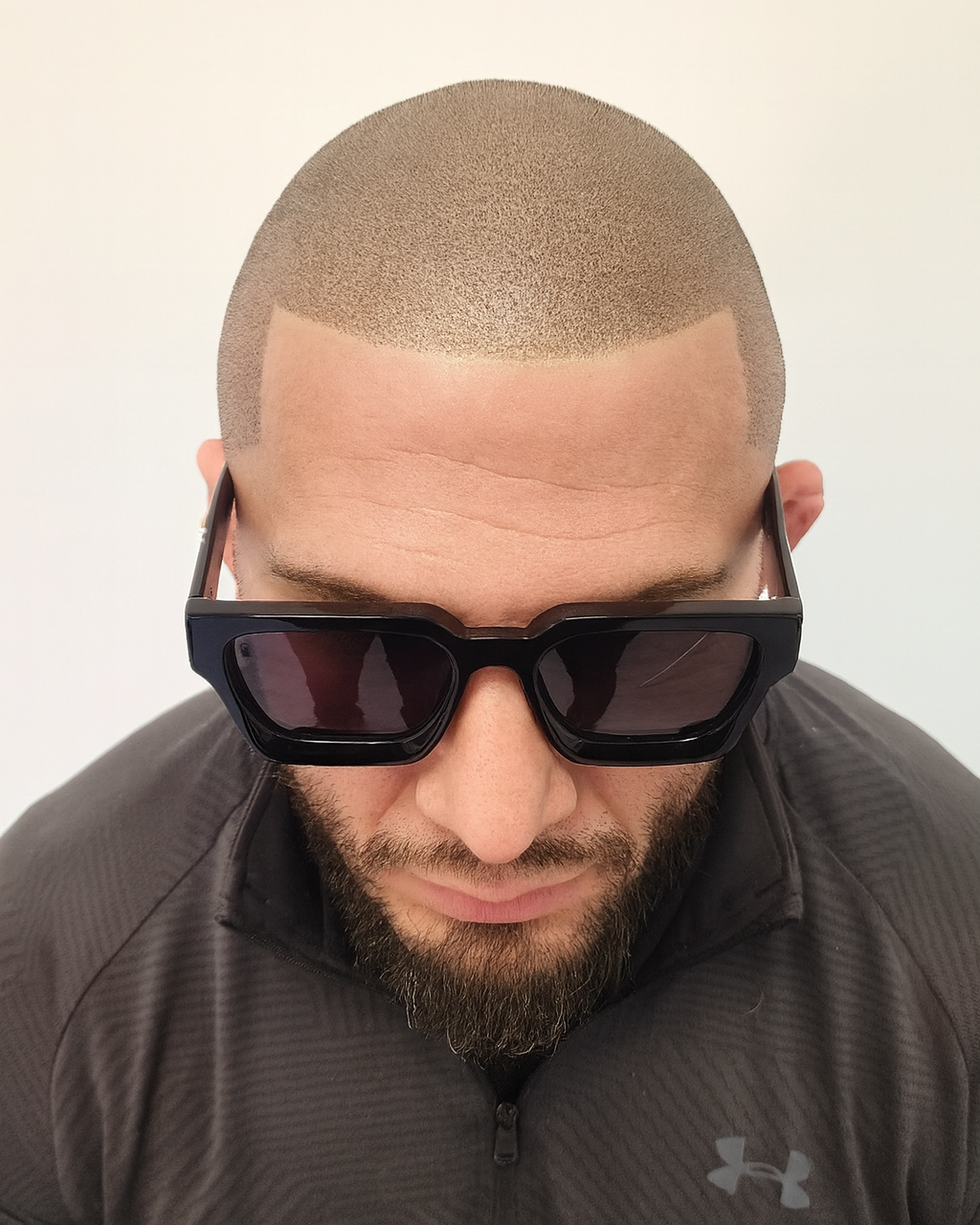 Natural scalp micropigmentation hairline restoration showing a clean, blended shaved-hair appearance
